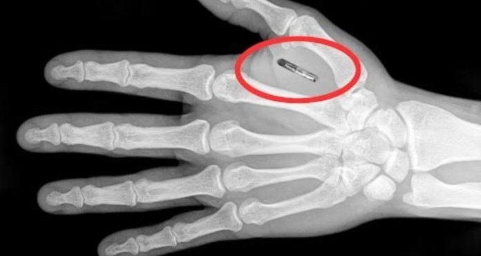 Microchips subcutáneos ¿seguros?